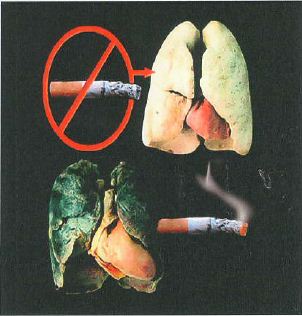 Madagascar 2012-2013 Health Effects lung - diseased organ, lung cancer, gross (image)